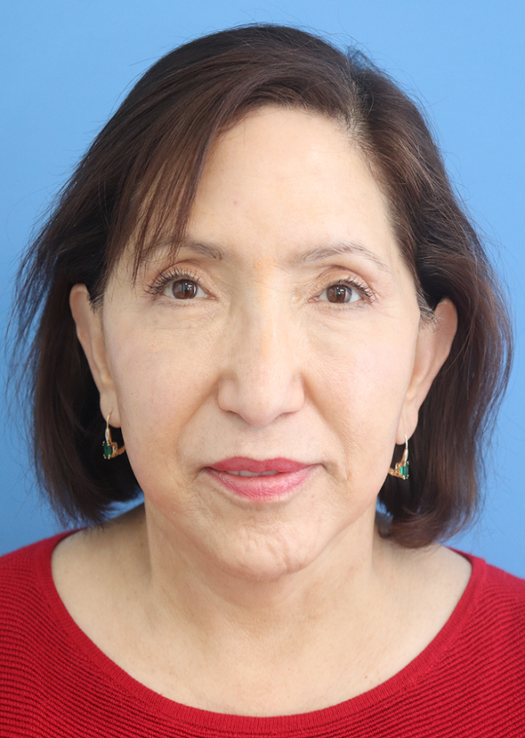 Facelift Before & After Gallery - Patient diFehSFNTWaHUy6bRecECQ - Image 4